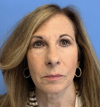 Facial-Rejuvenation---8211--Face-and-Neck-Lift--Upper--amp--Lower-Eyelid-Lift | After Facelift